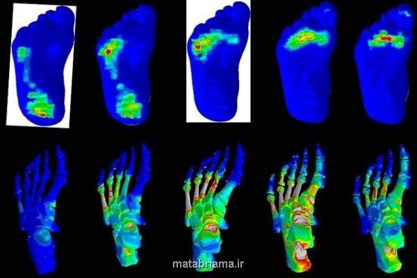 بررسی انگشتان پای دیابتی ها برای طراحی کفش و کفی طبی