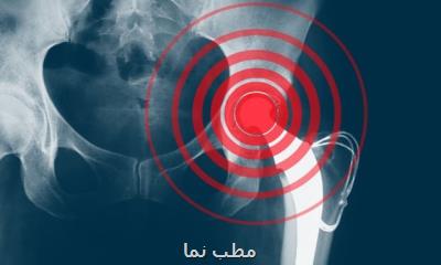 برآورد بار اقتصادی پوکی استخوان در سال ۲۰۲۰ در ایران