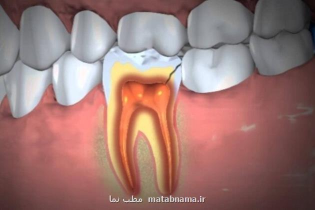 رویکردی مؤثر برای درمان پریودنتیت با استخراج سلول های پاپیلای آپیکال