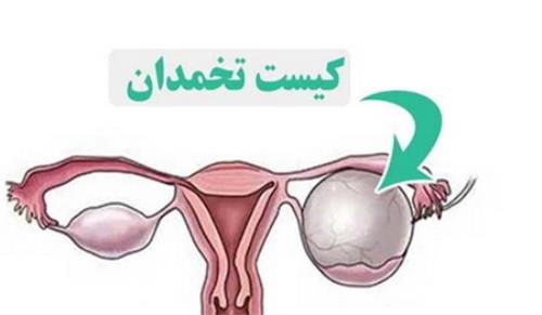 کیست تخمدان مشکل شایع اما اغلب بی خطر در زنان