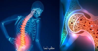 افراد بالای 50 سال بیماری پوكی استخوان را جدی بگیرند